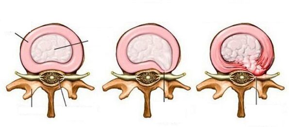Zwischenwirbelhernie mit zervikaler Osteochondose