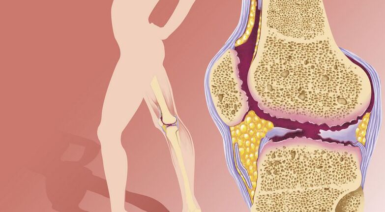 Übergewicht führt zu Arthrose